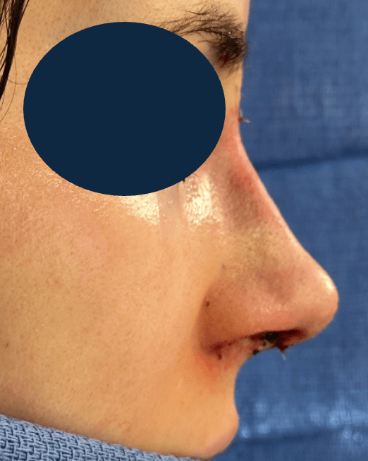 Rhinoplasty - After
