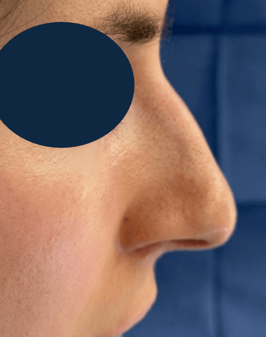 Rhinoplasty - Before