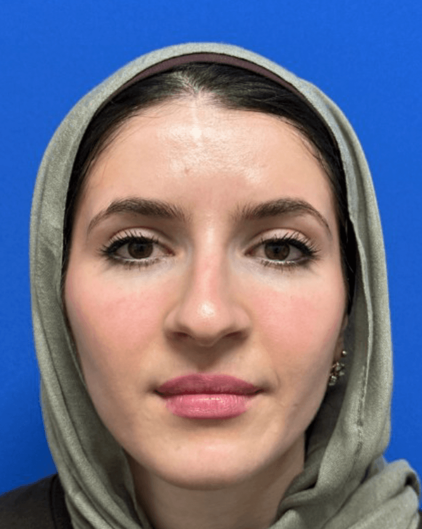 Rhinoplasty - Before