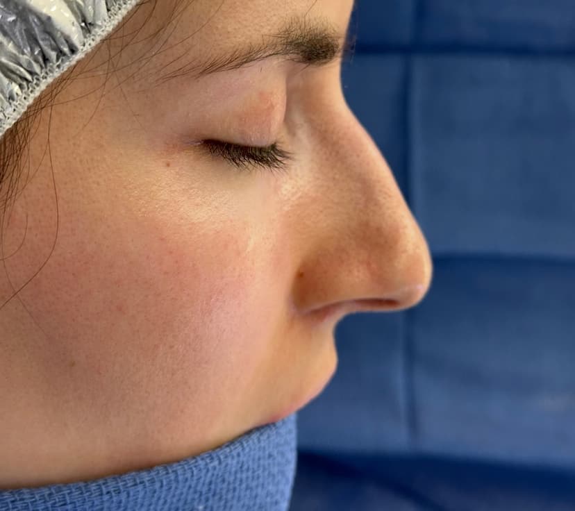 Rhinoplasty - Before