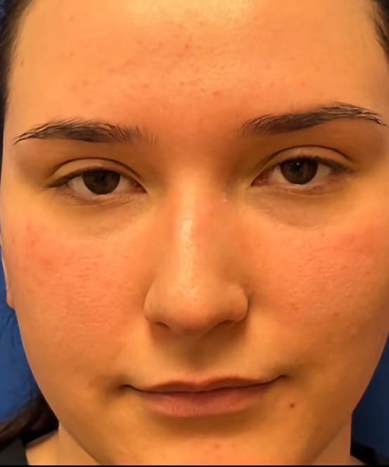 Rhinoplasty - Before