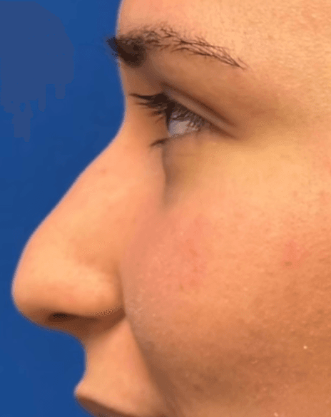 Rhinoplasty - Before