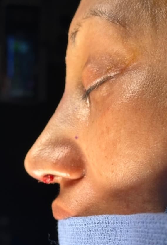 Rhinoplasty - After