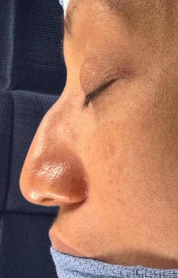 Rhinoplasty - Before