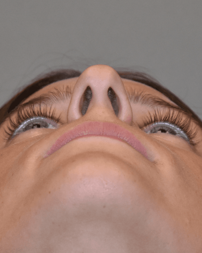 Rhinoplasty - Before