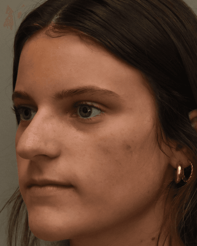 Rhinoplasty - Before