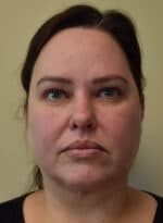 Deep Plane Facelift - Before