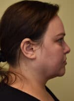 Deep Plane Facelift - Before