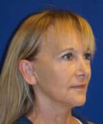 Deep Plane Facelift - After