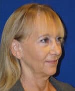 Deep Plane Facelift - Before