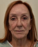 Deep Plane Facelift - Before