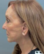 Deep Plane Facelift - After