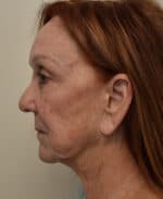 Deep Plane Facelift - Before