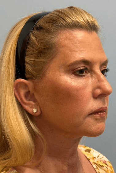 Deep Plane Facelift, Blepharoplasty, Fat Transfer - After