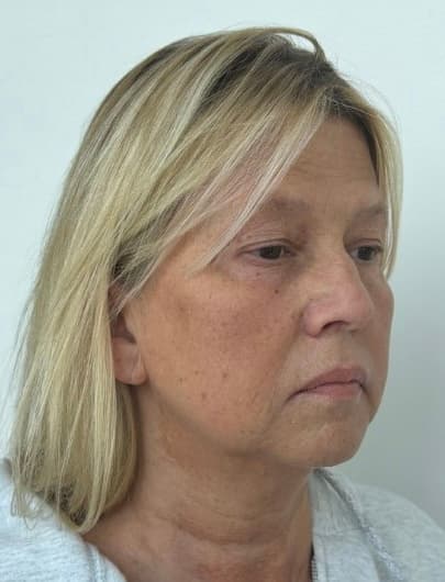 Deep Plane Facelift, Blepharoplasty, Fat Transfer - Before