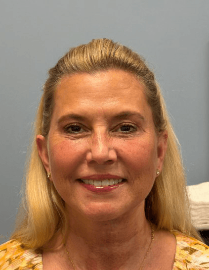 Deep Plane Facelift, Blepharoplasty, Fat Transfer - After