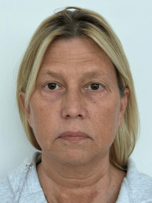 Deep Plane Facelift, Blepharoplasty, Fat Transfer - Before