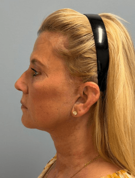 Deep Plane Facelift, Blepharoplasty, Fat Transfer - After