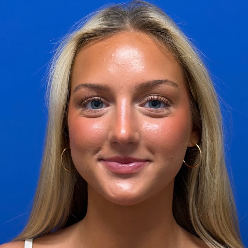 Rhinoplasty - After