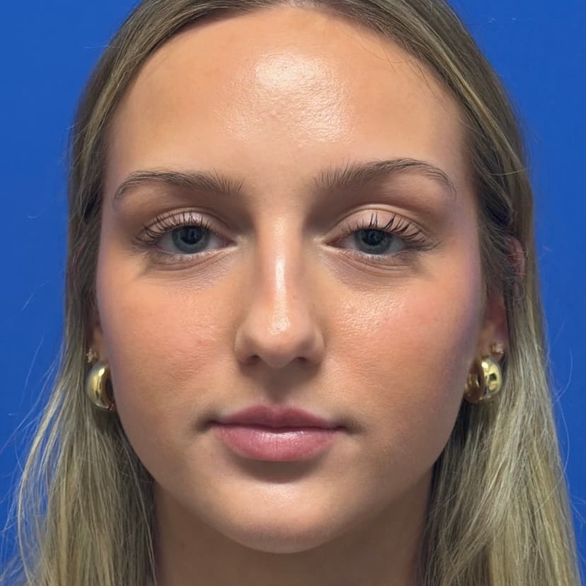 Rhinoplasty - Before