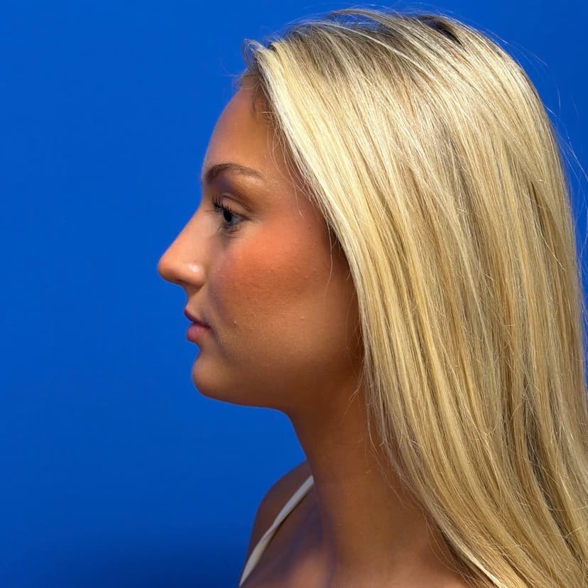 Rhinoplasty - After