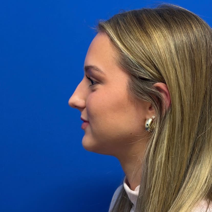 Rhinoplasty - Before